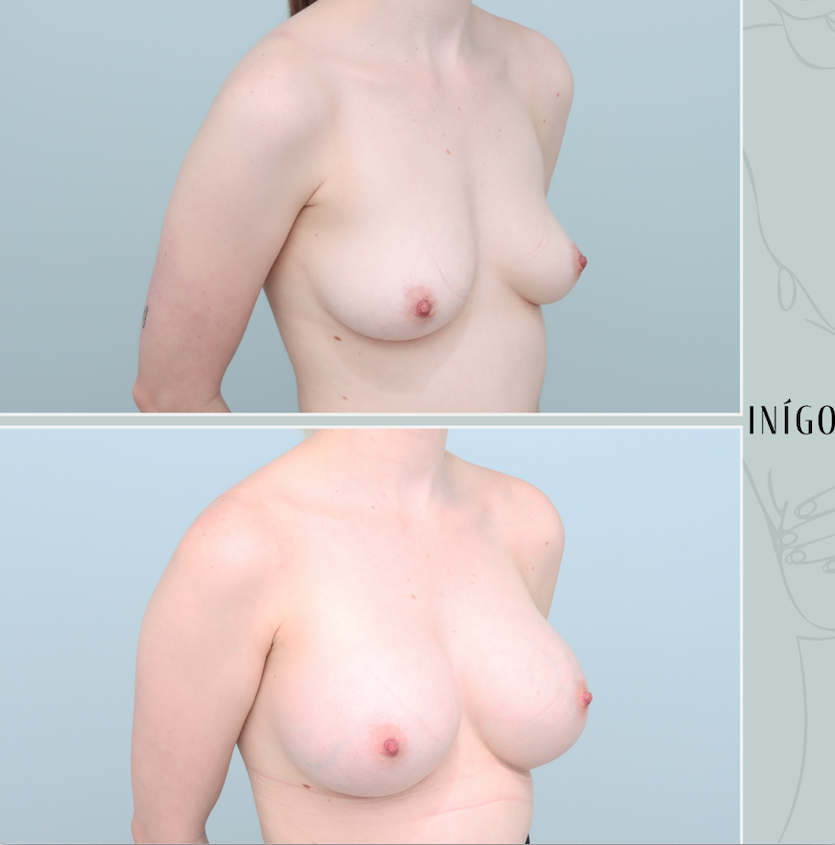 Breast Augmentation with Mentor implants, High profile, 350cc