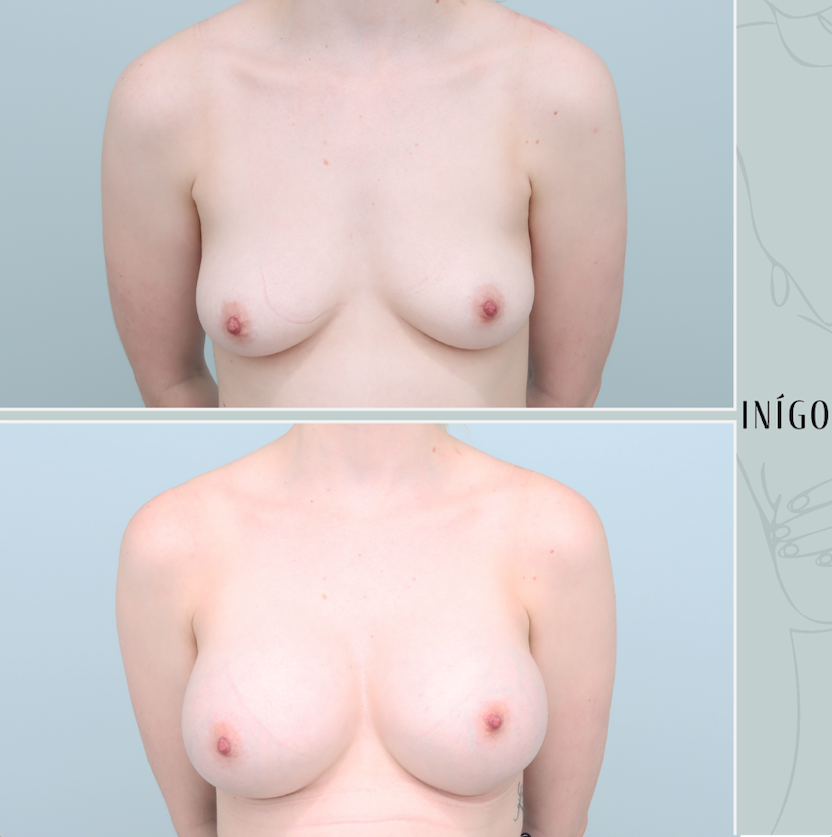 Breast Augmentation with Mentor implants, High profile, 350cc
