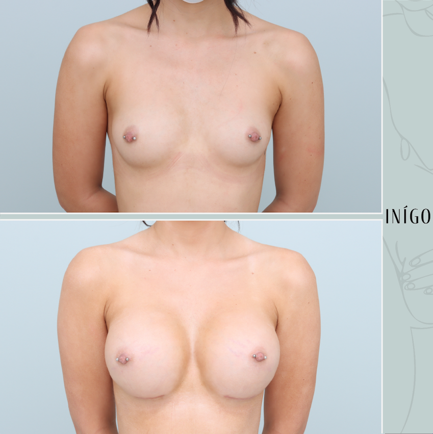Breast Augmentation with Mentor implants, dual plane, ultra high plus profile, 430cc