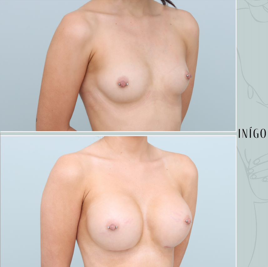 Breast Augmentation with Mentor implants, dual plane, ultra high plus profile, 430cc