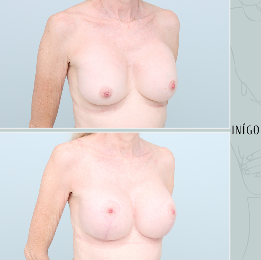 Removal &amp; replacement with Mastopexy, Mentor implants, dual plane, 400cc
