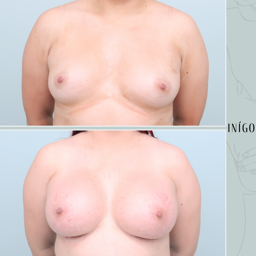 Breast Augmentation with Mentor implants, dual plane, 620cc