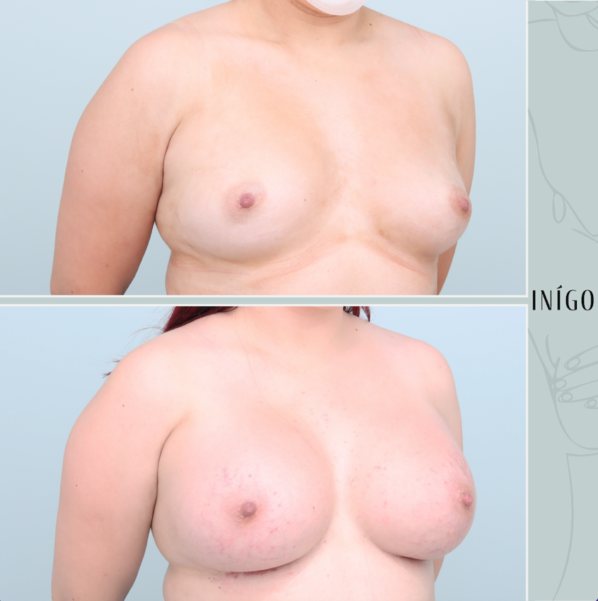 Breast Augmentation with Mentor implants, dual plane, 620cc