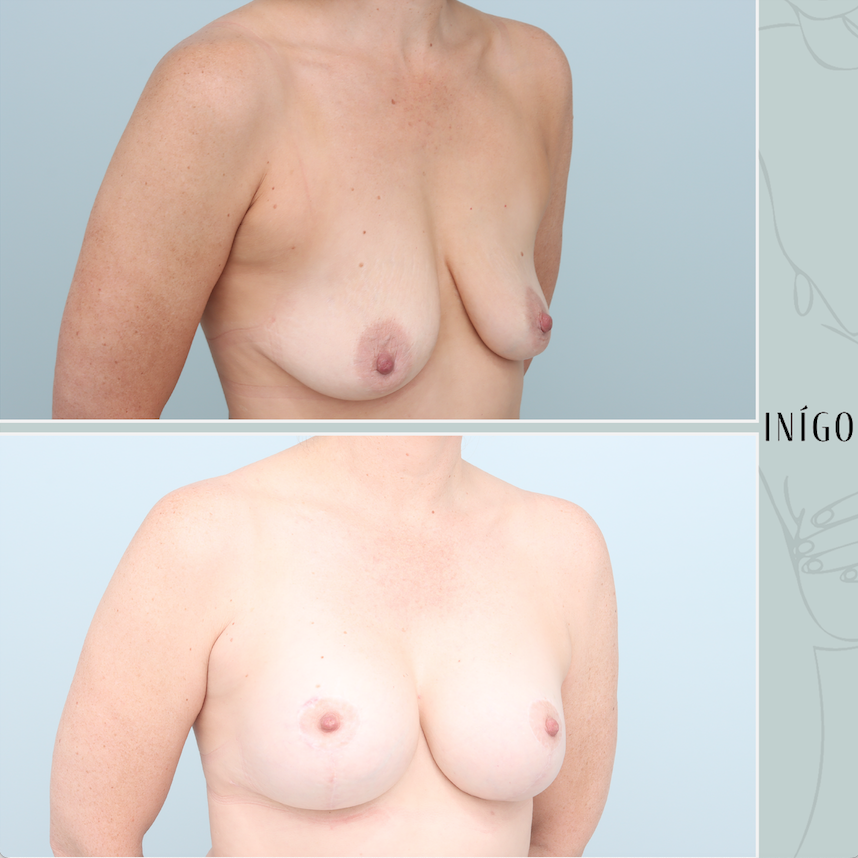 Breast augmentation and Mastopexy with Mentor implants, dual plane, high profile, 350cc