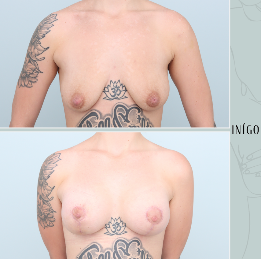 Breast Augmentation with Mastopexy, Mentor implants, dual plane, 375cc &amp; 425cc