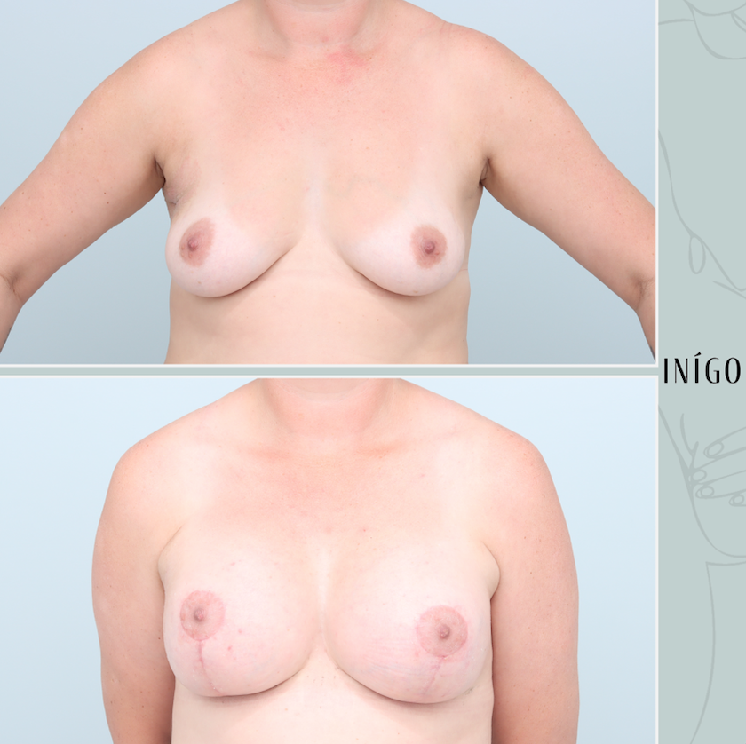 Breast Augmentation with Mastopexy, Mentor implants, dual plane, 425cc