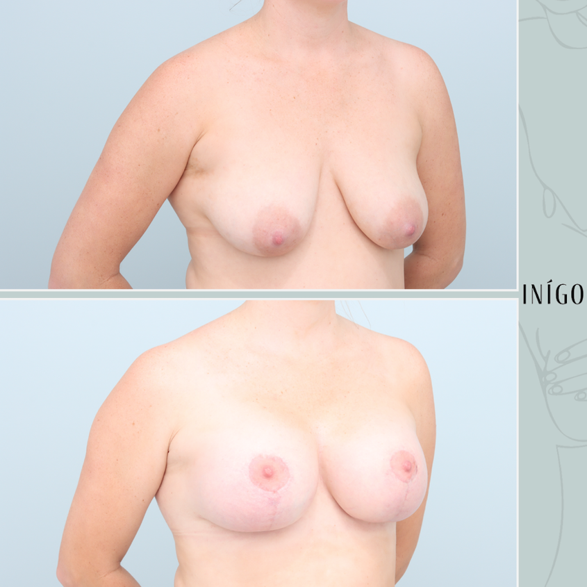 Breast Augmentation with Mastopexy, Mentor implants, dual plane, 400cc
