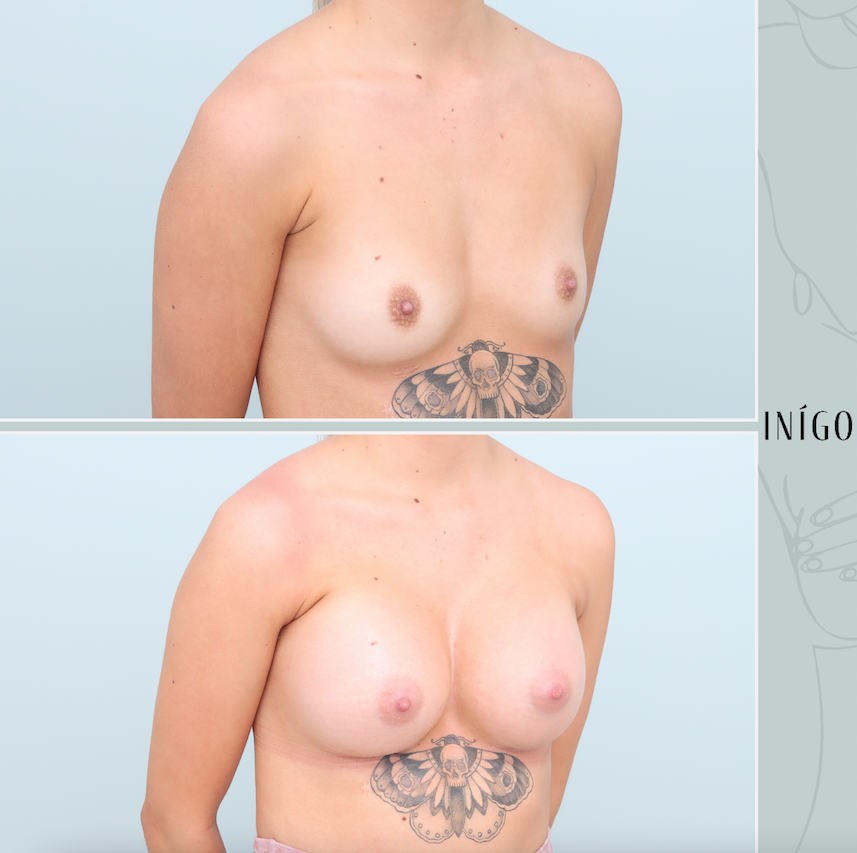 Breast Augmentation with Mentor implants, dual plane, 430-480cc