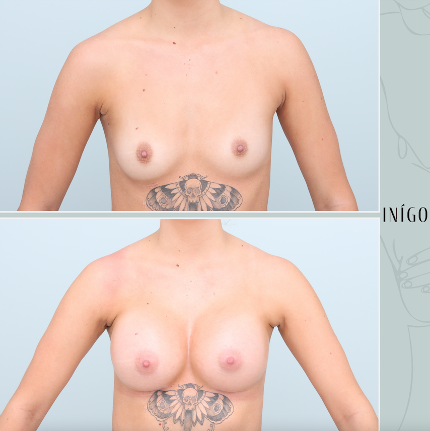 Breast Augmentation with Mentor implants, dual plane, 430-480cc