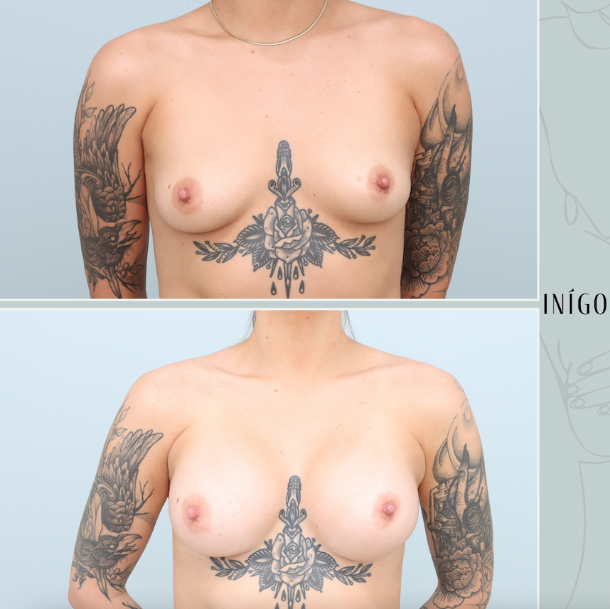 Breast Augmentation with Mentor implants, dual plane, high profile, 340cc
