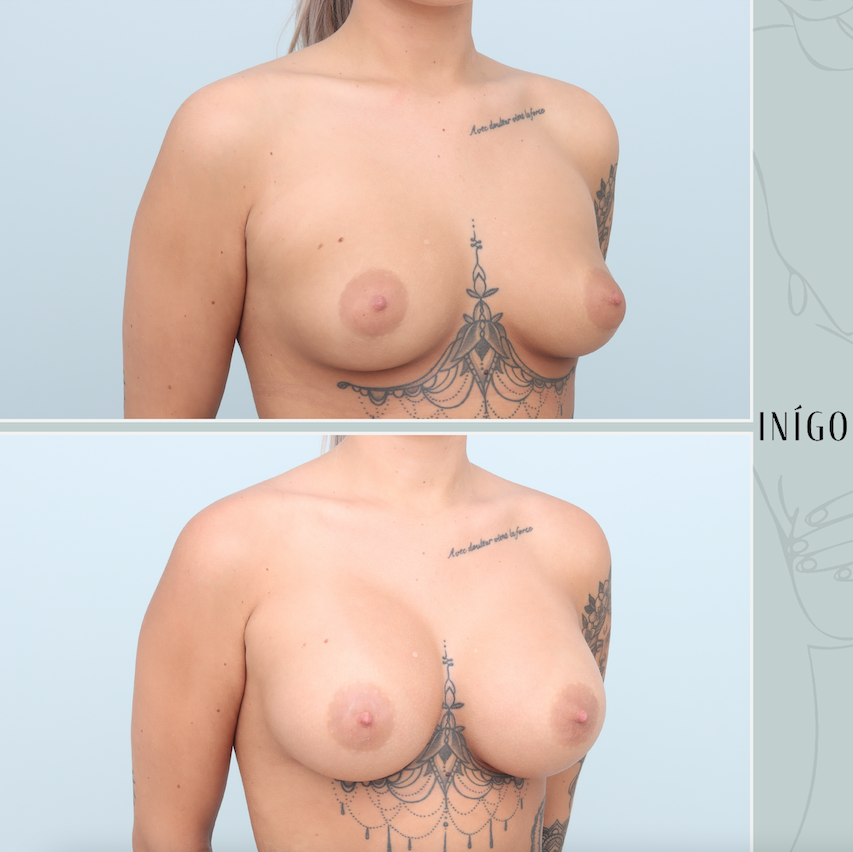 Breast Augmentation with Motiva implants, dual plane, high profile, 425cc