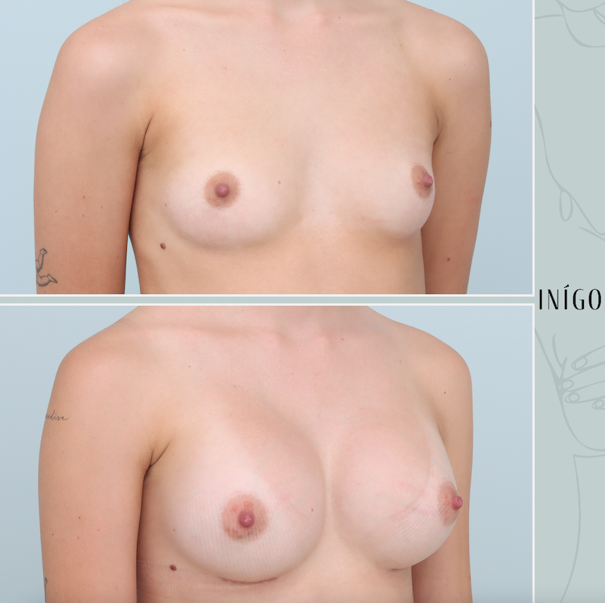 Breast Augmentation with Mentor implants, dual plane, 350cc