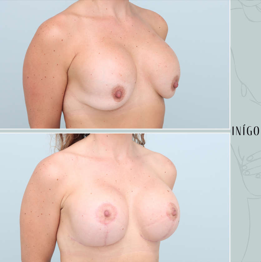 Removal &amp; replacement with Mastopexy, Mentor implants, dual plane, 435cc