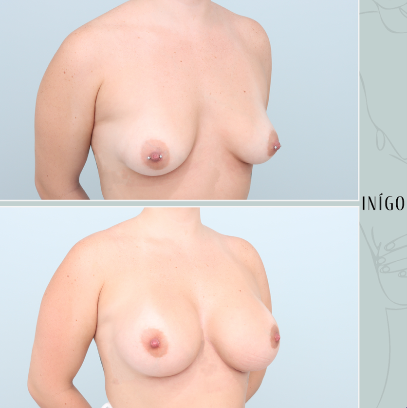 Breast Augmentation with Mentor implants, dual plane, 425 450cc