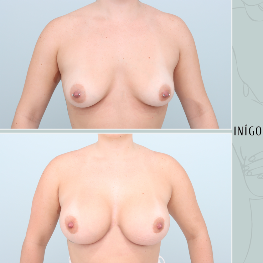 Breast Augmentation with Mentor implants, dual plane, 425 450cc